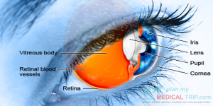 Lensectomy +Vit + Iris Claw Under