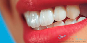 Teeth Whitening - Per Arch