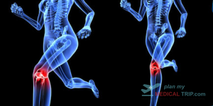 X-Ray Both Knees - Lateral