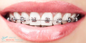 Ortho Treatment - Metal