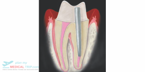 Post and Core