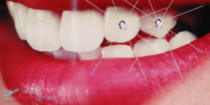 Teeth Jewelry