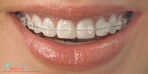 Ortho Treatment - Ceramic