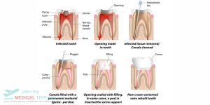 Root Canal + All Ceramic