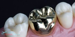 Root Canal + Metal Crown