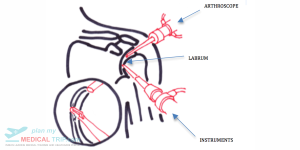 Arthroscopy - Shoulder