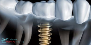 Single Dental Implant